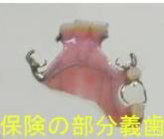 レジン床義歯